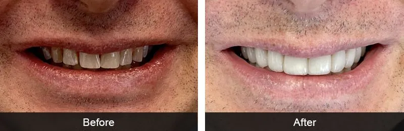 Original before and after photographs — Full Mouth Rehabilitation, case 77