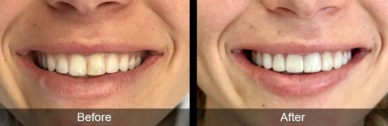 Original before and after photographs — Porcelain Veneers, case 33