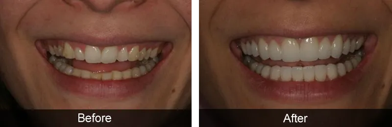 Original before and after photographs — Porcelain Veneers, case 64