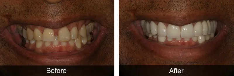 Original before and after photographs — Dental Implants, case 13