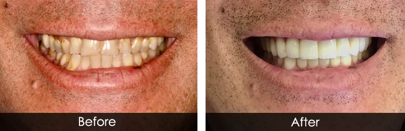 Original before and after photographs — Full Mouth Rehabilitation, case 91