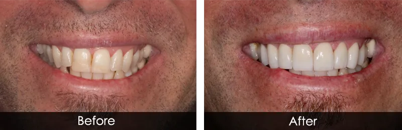 Original before and after photographs — Gum Sculpting, case 2