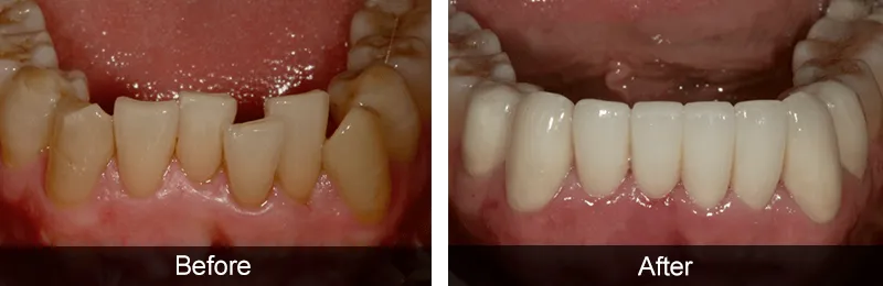 Original before and after photographs — Porcelain Veneers, case 46