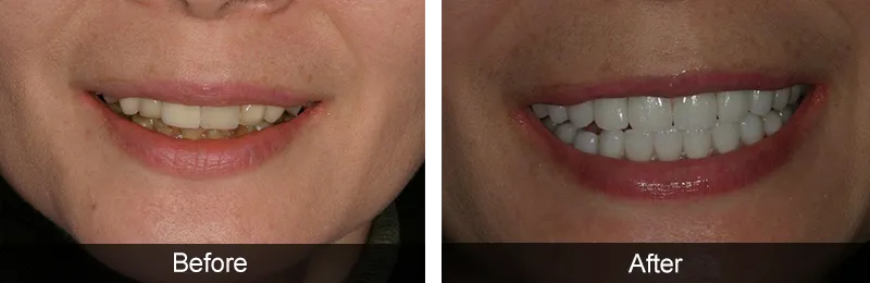 Original before and after photographs — Porcelain Crowns, case 30