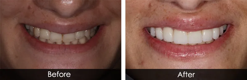 Original before and after photographs — Porcelain Veneers, case 72