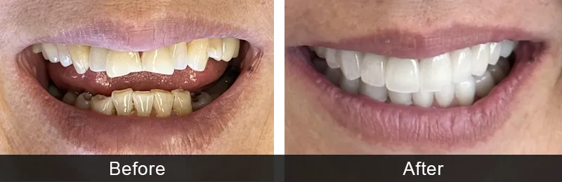 Original before and after photographs — Porcelain Veneers, case 34