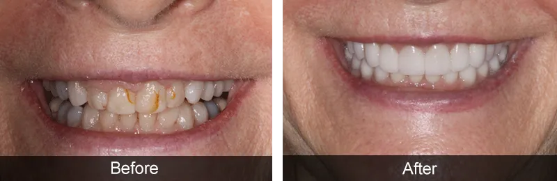 Original before and after photographs — Gum Sculpting, case 5