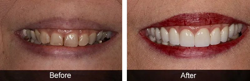 Original before and after photographs — Full Mouth Rehabilitation, case 90