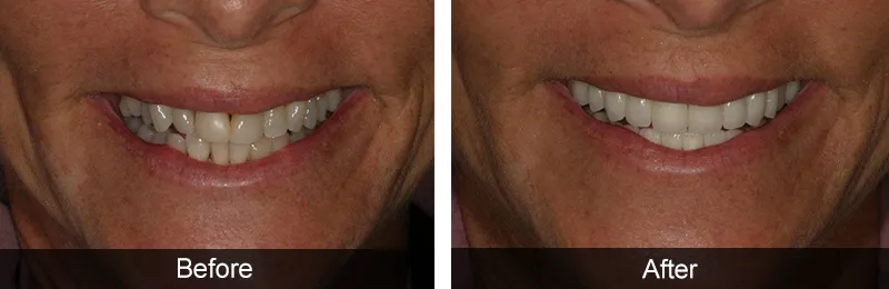 Original before and after photographs — Porcelain Veneers, case 52