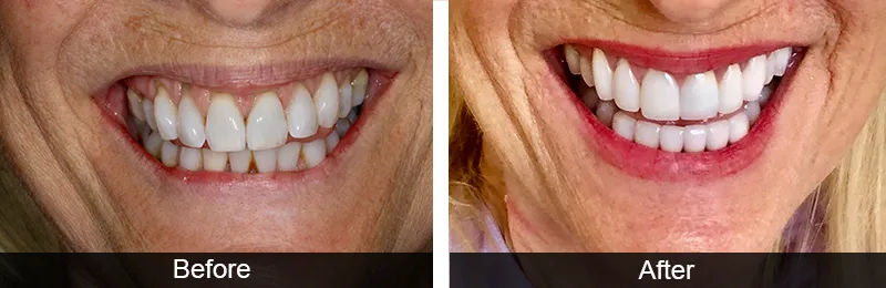 Original before and after photographs — Porcelain Veneers, case 37
