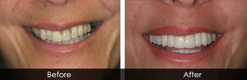 Original before and after photographs — Full Mouth Rehabilitation, case 78