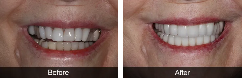 Original before and after photographs — Porcelain Crowns, case 22
