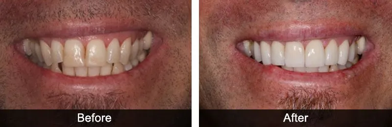 Original before and after photographs — Porcelain Veneers, case 39