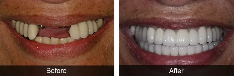 Original before and after photographs — Full Mouth Rehabilitation, case 85