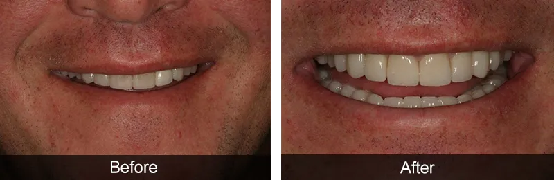 Original before and after photographs — Porcelain Crowns, case 25