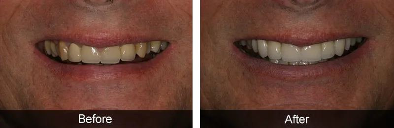 Original before and after photographs — Porcelain Veneers, case 47