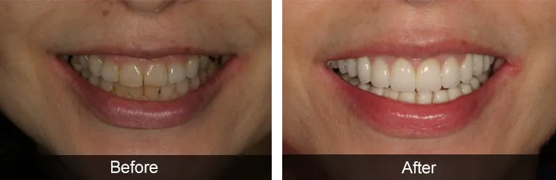 Original before and after photographs — Porcelain Veneers, case 68